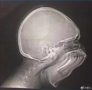 拍牙片時打了個哈欠，變成了毒液？用3D打印技術制作牙齒的好處